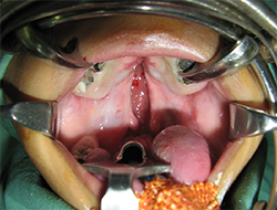 Postoperative Airway Complications after Cleft Palate Repair